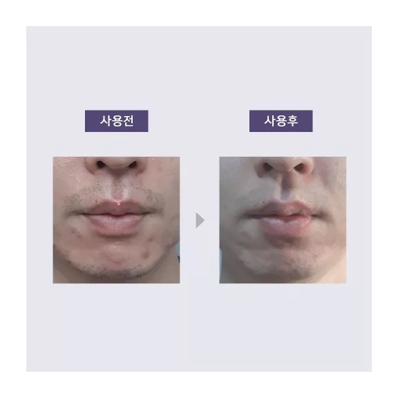 ANACIS Acleon Advanced Blemish Spot Concentrate pattanás elleni koncentrátum 30 ml