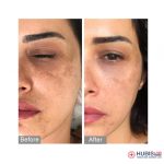 HUBISLAB Derma Max professzionális bőrfehérítő szérum - Megújult