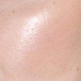 Zsíros, kevert bőr