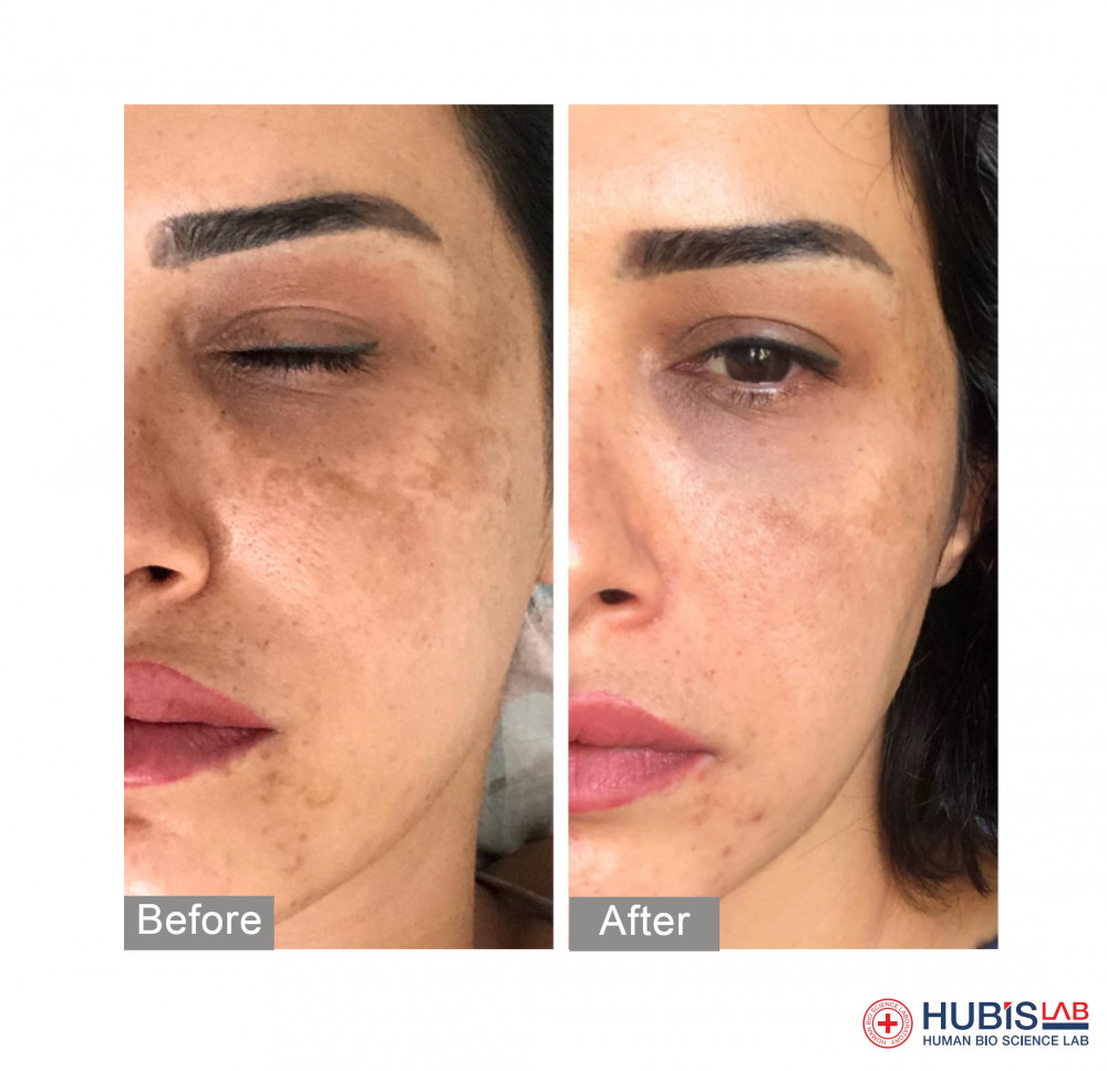HUBISLAB Derma Max professzionális bőrfehérítő krém - Megújult